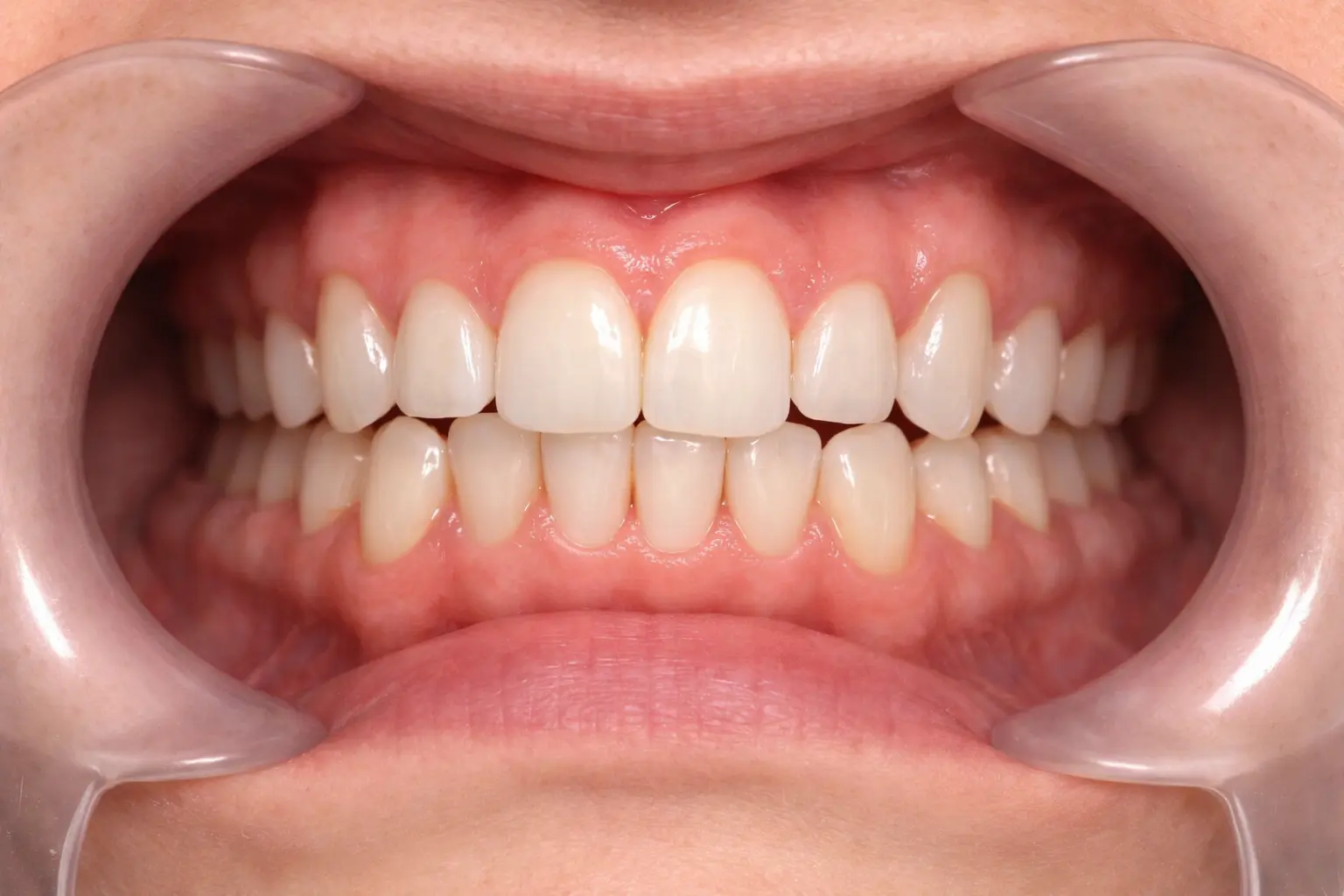 After treatment
