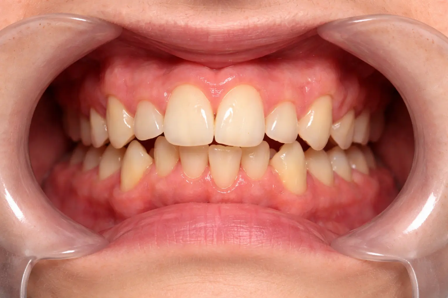 Before treatment